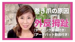 巻き爪の原因のひとつである「外反母趾」について※テーピング・アーチパットの貼り方動画付き