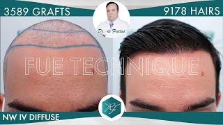 Hair Graft Technique FUE- 3.589 Grafts (9.178 Hairs) - Dr. de Freitas