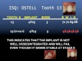 dr. jay malmquist the isq what do the numbers mean