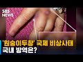 WHO, '원숭이두창' 국제 비상사태 선언…국내 방역은? / SBS