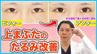 【上まぶたのたるみ改善】眉下切開と眼瞼下垂とこめかみリフトを比較解説