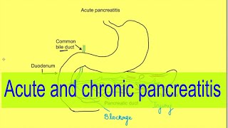 Acute and chronic pancreatitis | Gastrointestinal pathology | Medicine