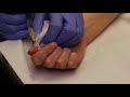 Fingernail Punch Biopsy