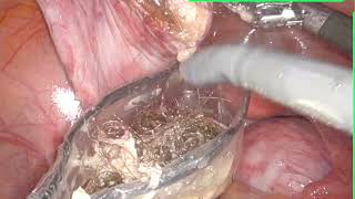 Laparoscopic Removal of Bilateral Dermoid Cysts