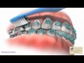 Brushing with Braces - Wellington Village Orthodontics