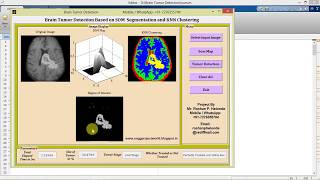 Brain Tumor Detection Using Segmentation Matlab Project with Source Code