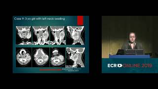 Differencial Diagnosis of Pediatric Neck Lesion