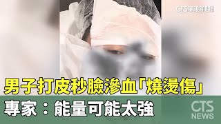 男子打皮秒臉滲血「燒燙傷」　專家：能量可能太強｜華視新聞 20241223@CtsTw