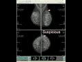 breast imaging boot camp calcifications