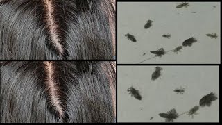 Head Lice Nit Picking/Traditional Head Lice Nit Picking/Nit Lice Picking With Real Sound