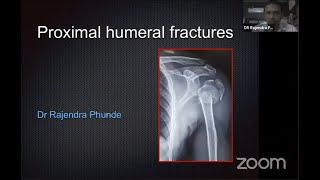 Proximal Humeral Fractures - Dr Rajendra Phunde