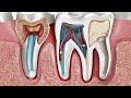 Demystifying Root Canals - What to Expect and How to Ease Your Fears?