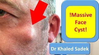 5 year Face Cyst. Cyst Removal Clinic London. LipomaCyst.com Dr Khaled Sadek