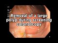 Removal of a large polyp found during a screening colonoscopy. THESE HAVE NO SYMPTOMS!