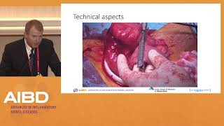 IBD Surgery Debate 1: Ileocecal Crohn's disease