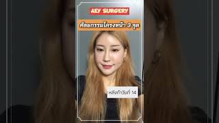 รีวิวศัลยกรรมโครงหน้า 3 จุด #aeysurgery #ศัลยกรรมเกาหลี #ที่ปรึกษาศัลยกรรม #รีวิวศัลยกรรมเกาหลี