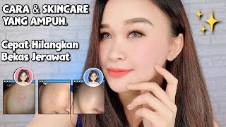 😍Cara Menghilangkan Bekas Jerawat dengan Cepat - Dengan kebiasaan & produk