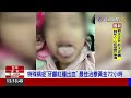 4歲女童長水泡高燒3天 醫：易誤診為腸病毒