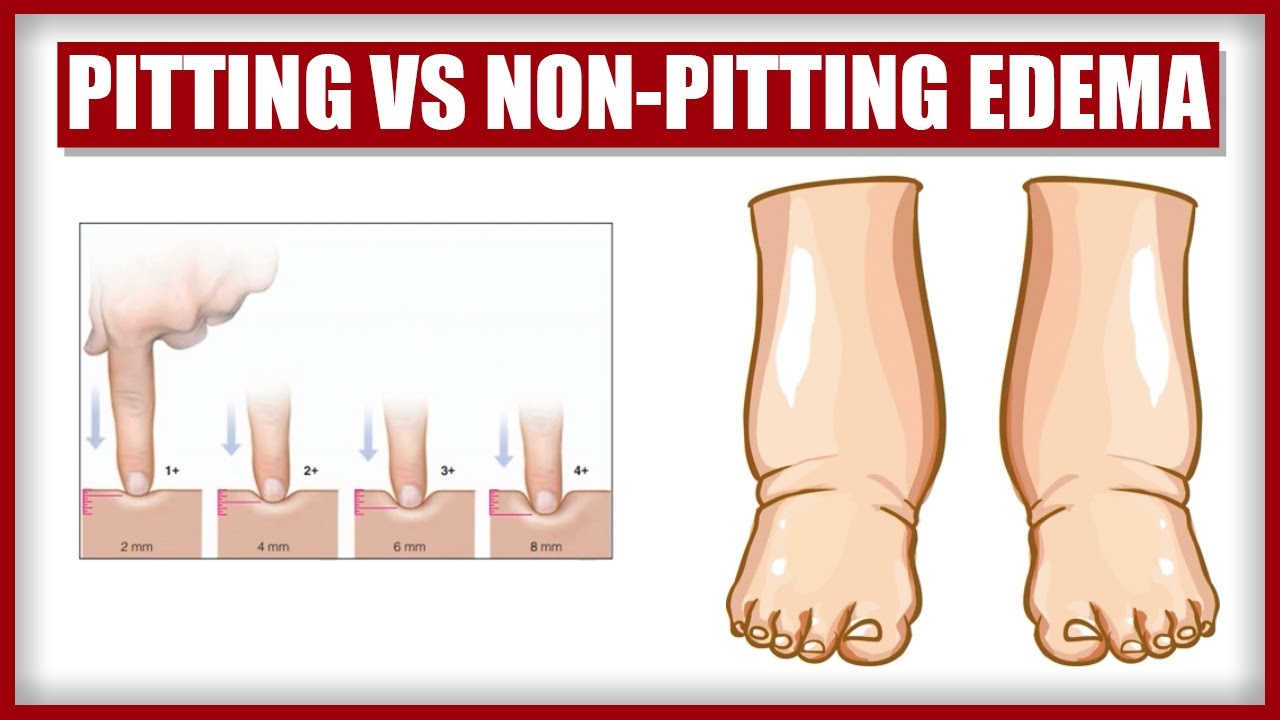 Pitting Edema Scale 1 4