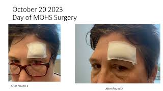 MOHS surgery for basal cell carcinoma on forehead