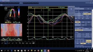 Echo-Pac analysis