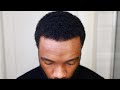 Hair Transplant Month 7