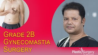 গ্রেড ২ গাইনাকোম্যাস্টিয়া সার্জারি | Grade 2B gynecomastia surgery | Male breast reduction surgery