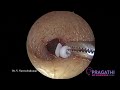 endoscopic myringotomy with grommet insertion dr. v. narendrakumar