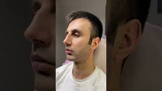 Jawline Dolgu işlemi öncesi ve sonrası #jawlinedolgu  #jawlinefiller  #jawline  #çenedolgusu