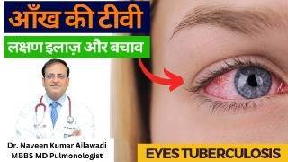 Eyes tuberculosis | आँख की टीवी लक्षण इलाज़ और बचाव | Dr Naveen Ailawadi | #lungdoctor #tbdoctor