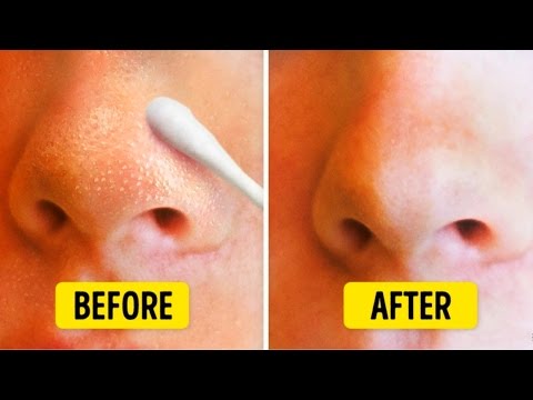 9 NATURAL WAYS TO GET RID OF BLACKHEADS 9 NATURAL WAYS TO GET RID OF BLACKHEADS