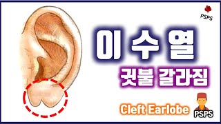 이수열(귓불갈라짐)을 가장 깔끔하게 없애는 방법은? (feat. 성형외과전문의)