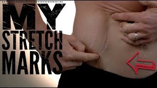 My Stretch Mark Story: How to Reduce the Appearance of Stretch marks- Thomas DeLauer