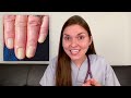 doctor explains what your nails say about your health top 10 nail problems