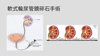 【衛教投影片】軟式輸尿管鏡碎石手術 Flexible ureterorenoscopy (RIRS)