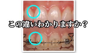 歯ぐきから血が出る！なぜか知ってますか？【歯科衛生士】