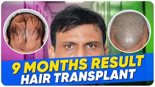 Hair Transplant in Bangalore | Best Results & Cost of Hair Transplant in Bangalore