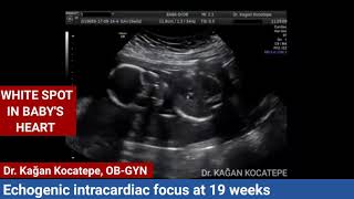 Echogenic intracardiac focus on fetal ultrasound. Is it a heart disease? When will it go away?