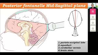 part 4 :: Neonatal Cranial sonography:: Posterior fontanelle planes :: Dr.Mohamed Soliman