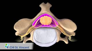 Posterior Cervical Laminectomy and Fusion