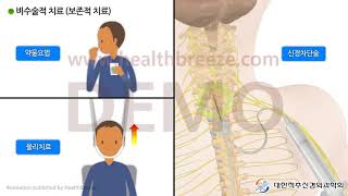 [시연용] a0029aako [대한척추신경외과학회] (1) 목디스크의 개념과 치료