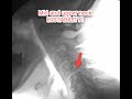 DMX Mid cervical and UPPER CERVICAL INSTABILITY!