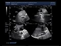 Ultrasound Video showing the Cirrhosis of the liver.