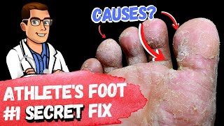🦶BEST 9 Athlete's Foot Fungus Remedies [& the #1 Big Mistake]🦶