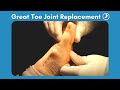 Great Toe Joint Replacement Surgery