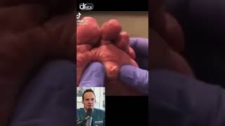 DOCTOR REACTS-EXPLODING CYST ON BOTTOM OF FOOT!😱#shorts #reaction