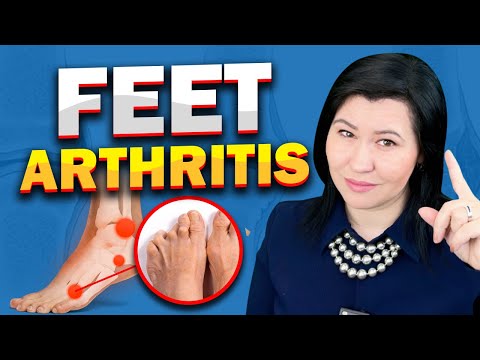 What are the signs of arthritis in your foot?