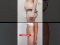 Abdominoplasty Post Pregnancy (Patient 1023) #shorts