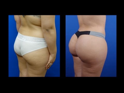 breast lift tx dallas cost Student big tits fucks computer guy
