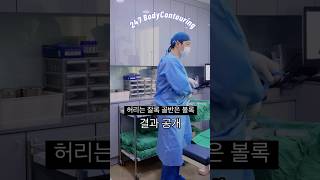 골반지방이식, 엉덩이지방이식 결과 공개 #shorts